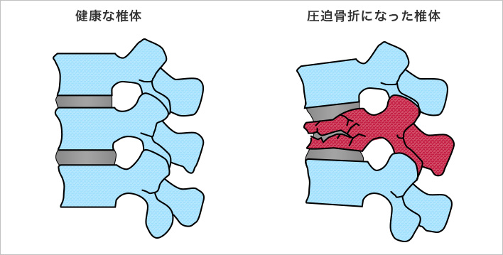 脊椎圧迫骨折