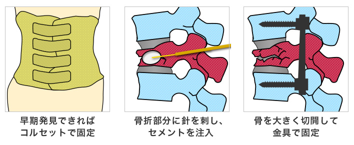 脊椎圧迫骨折 せきついあっぱくこっせつ 済生会