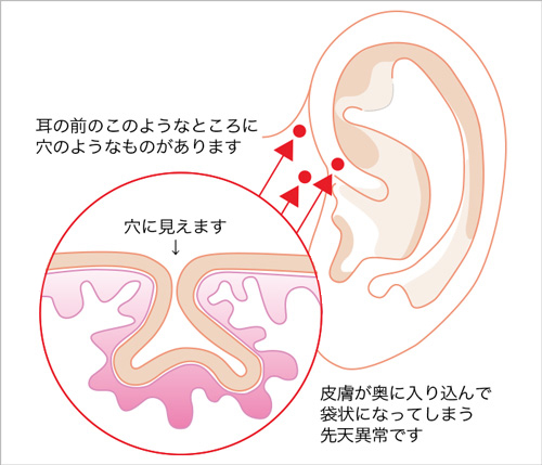 耳瘻孔の皮膚