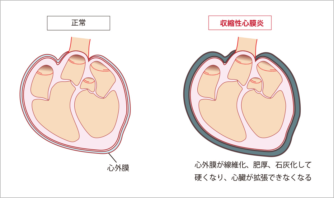 収縮性心膜炎