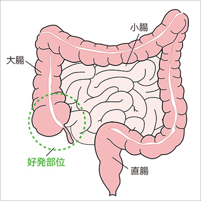 病 は クローン と