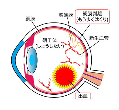 目の名称と糖尿病網膜症