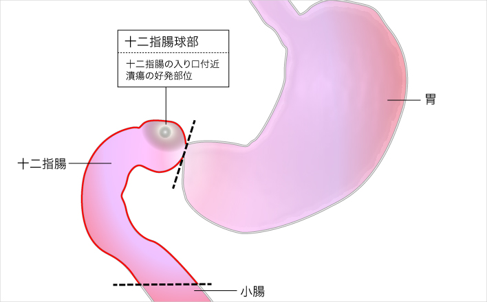 十二指腸潰瘍 じゅうにしちょうかいよう 済生会