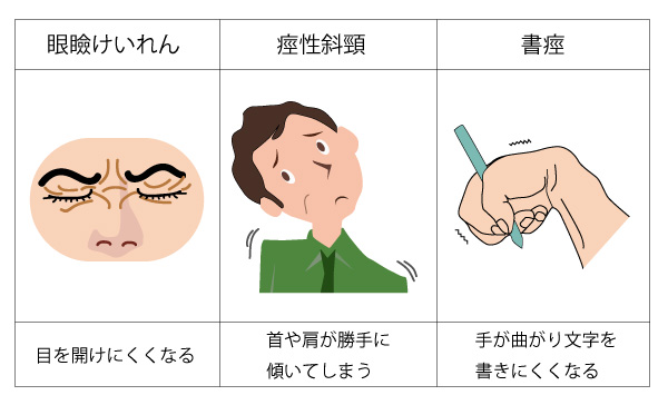 斜頸または頸部ジストニア：首の痛みを改善するにはどうすればよいですか？