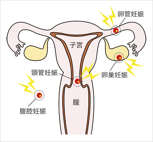 妊娠 子宮 と は 外