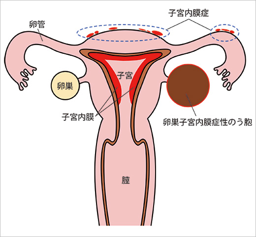 子宮の構造と子宮内膜症