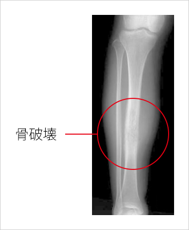 肉腫 症状 骨 初期 骨肉腫の初期症状は膝やすねの痛み？生存率は？治療はどうする？