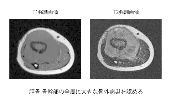 ユーイング肉腫(MRI画像)