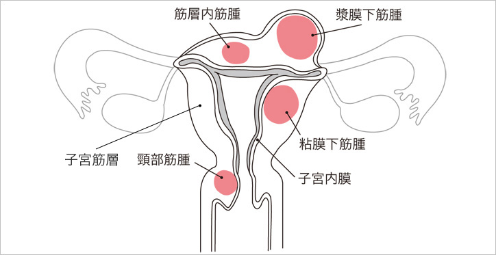 子宮筋腫