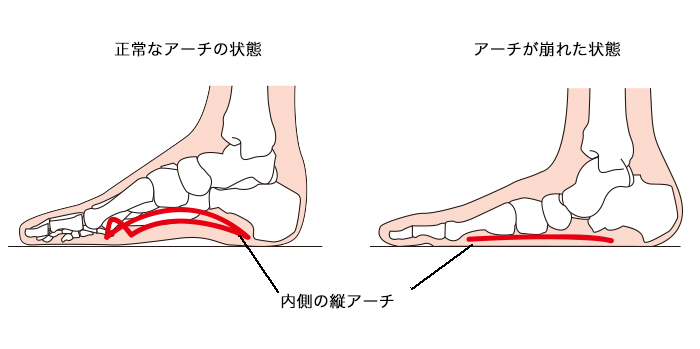 アーチの崩れ