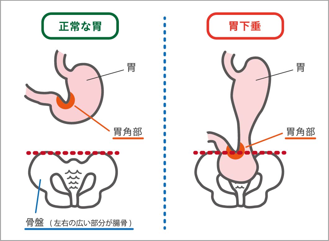 は 胃下垂 と 胃下垂について