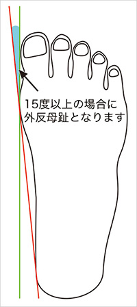 外反母趾のチェック方法