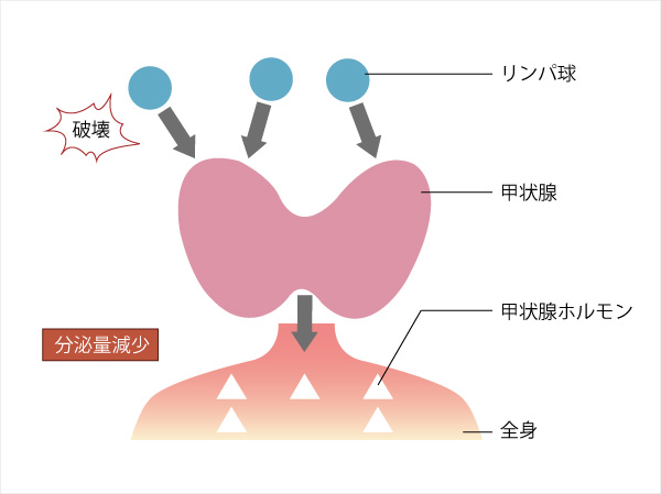 橋本病