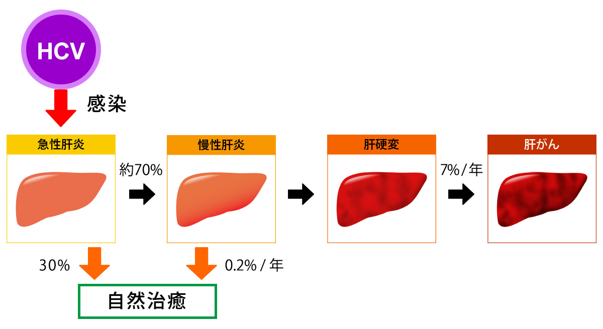 F型肝炎