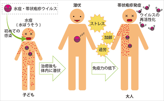 帯状疱疹が起こる仕組み