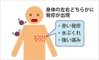 帯状疱疹 たいじょうほうしん 済生会