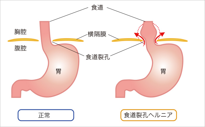 げっぷ 膵炎 症状 （どうしました）げっぷが多く出て困る 鈴木秀和さん＝訂正・おわびあり