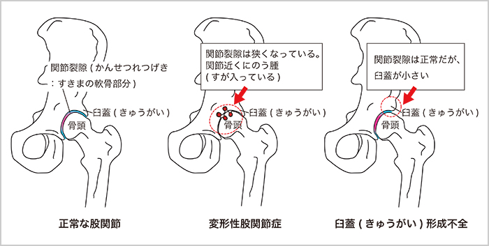 形成 股関節 臼 不全 蓋 股関節の痛みの原因となる寛骨臼形成不全（臼蓋形成不全）とは？ 症状や手術について