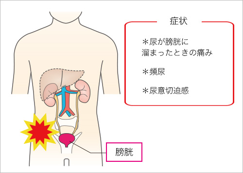 間質性膀胱炎 かんしつせいぼうこうえん 済生会