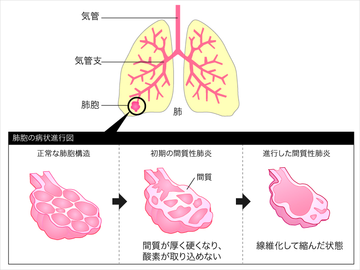 間 質 性 肺炎 治る