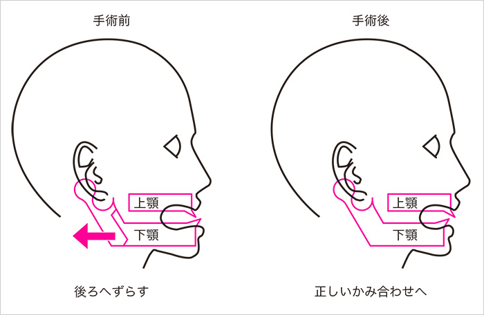 顎変形症の手術