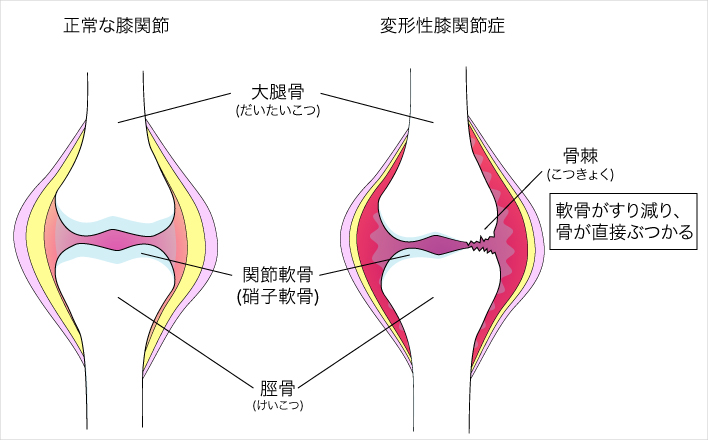 変形性膝関節症 へんけいせいひざかんせつしょう 済生会