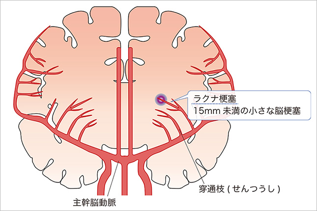 ラクナ梗塞