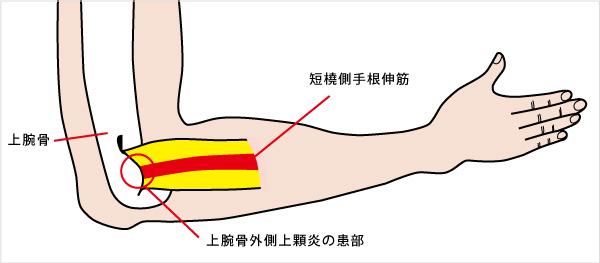 上腕骨外側上顆炎 通称 テニス肘 じょうわんこつがいそくじょうかえん 済生会