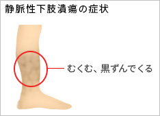 静脈性下肢潰瘍の症状