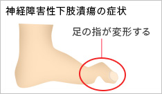 静脈性下肢潰瘍の症状