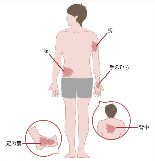 梅毒 ばいどく 済生会