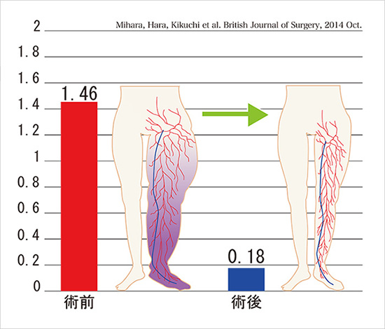 「リンパ管静脈吻合術」による蜂窩織炎発生抑制効果