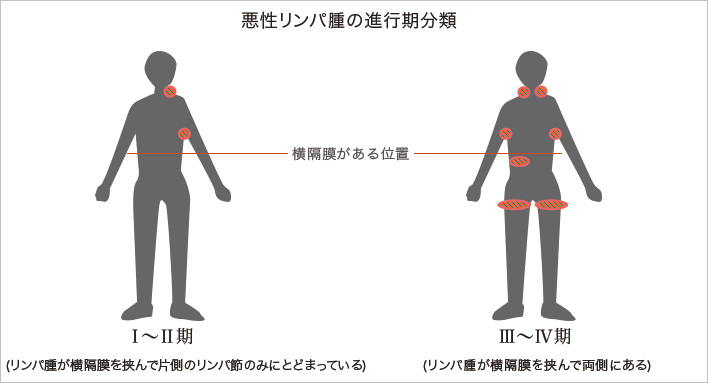 リンパ腫 悪性 濾胞 性 悪性リンパ腫の濾胞性リンパ腫低悪性度と診断されて、現在経過観察で病院に三