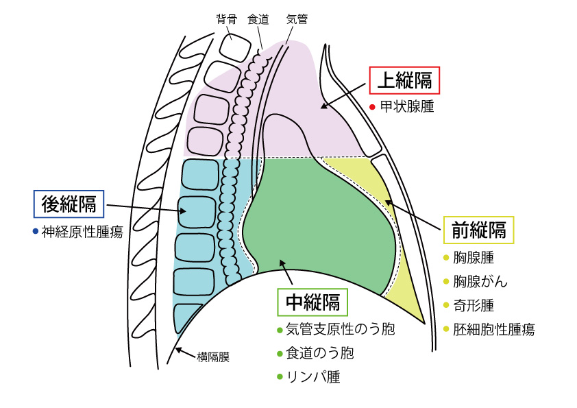 縦隔腫瘍 じゅうかくしゅよう 社会福祉法人 恩賜財団 済生会