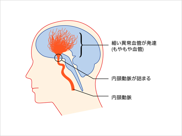 もやもや病の仕組み