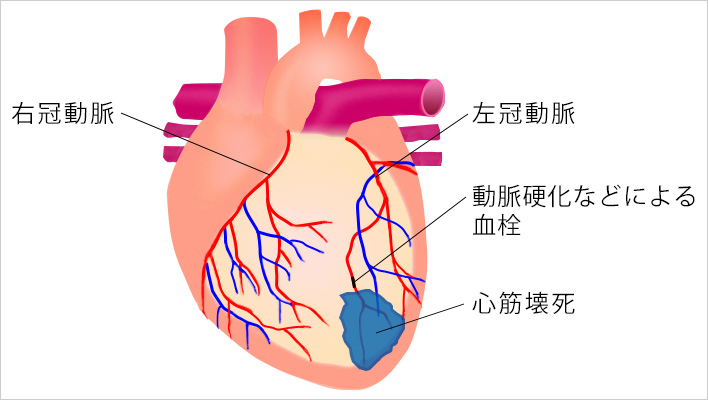 心筋梗塞