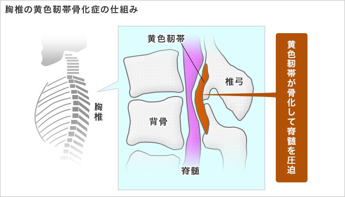 胸椎の黄色靭帯骨化症の仕組み