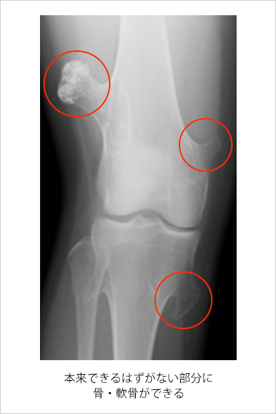 骨軟骨腫 こつなんこつしゅ 済生会