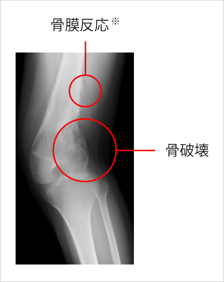 骨肉腫(膝関節)