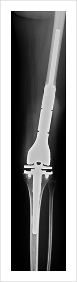 腫瘍用人工膝関節置換