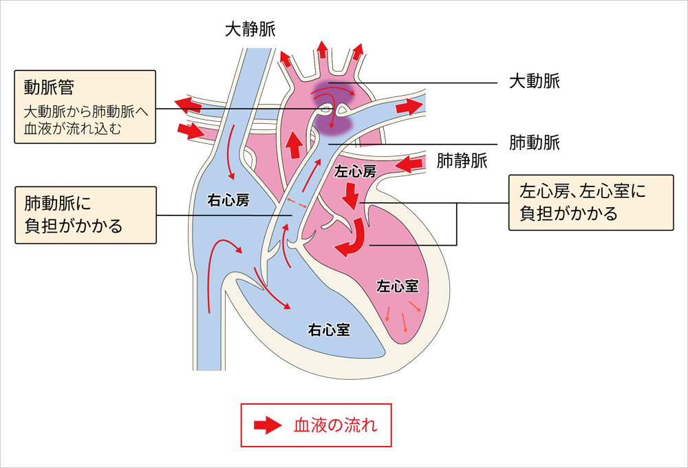 動脈管開存症