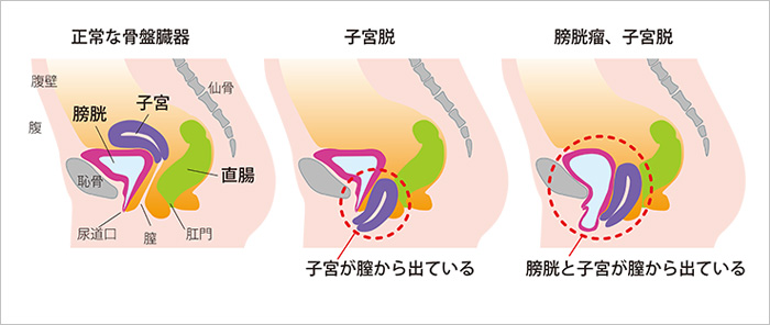 骨盤の横断面図