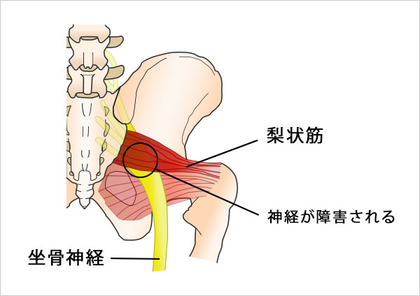 ランニング 股関 痛み 原因　梨状筋症候群