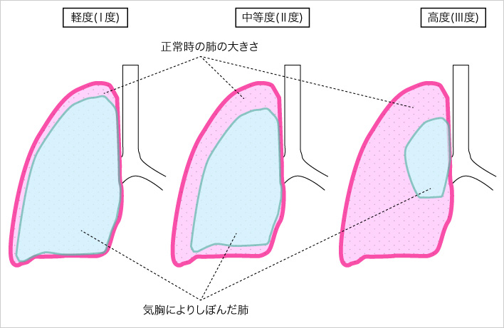 気胸の重症による分類