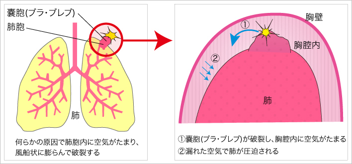 胸腔内にたまった空気が肺や心臓を圧迫する