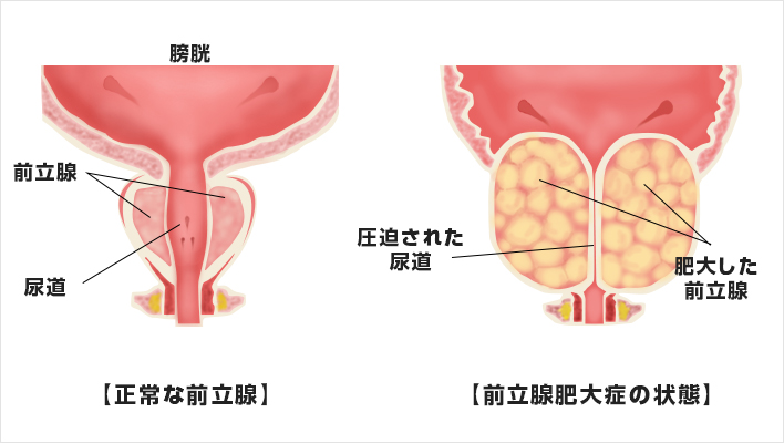 【正常な前立腺】 【前立腺肥大症の状態】