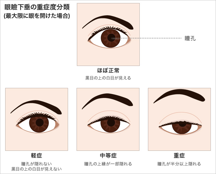 眼瞼下垂の重症度分類