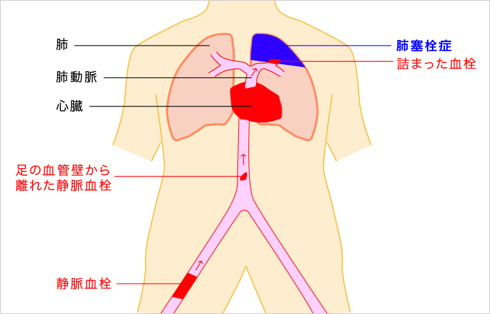 肺塞栓症 エコノミークラス症候群 はいそくせんしょう 社会福祉法人 恩賜財団 済生会