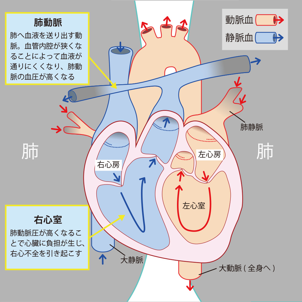 肺高血圧症の仕組み