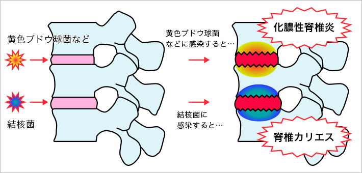 化膿性脊椎炎・脊椎カリエス